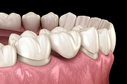 Couronne dentaire : votre dent de substitut, collée sur un reste de dent