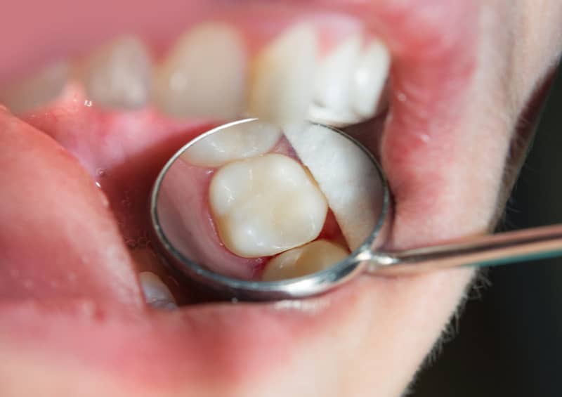 White fillings - Treatment for dental cavities -  image