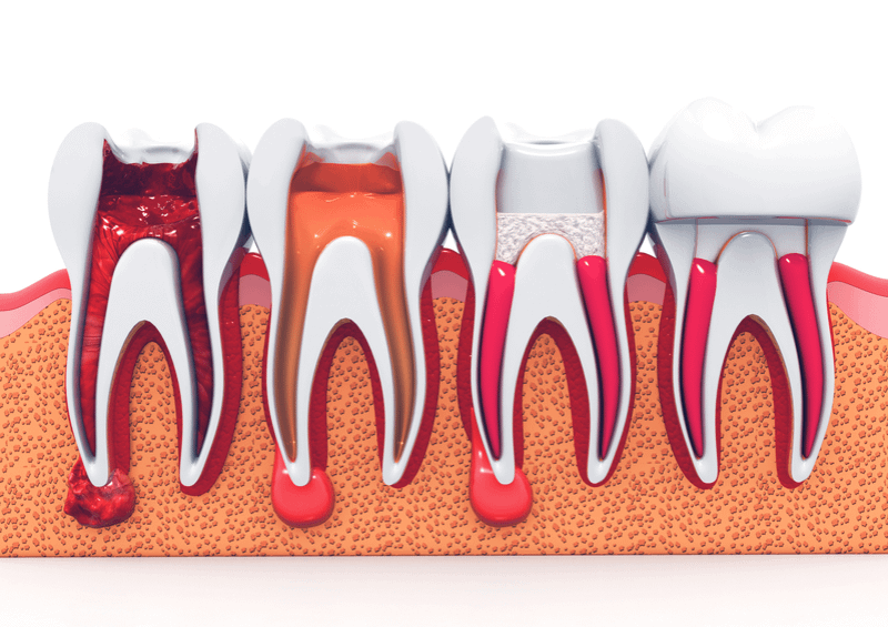 Root Canal Treatment - Endodontics -  image